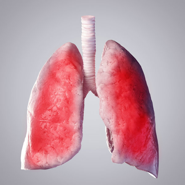 白肺病的症状是什么怎么治疗好